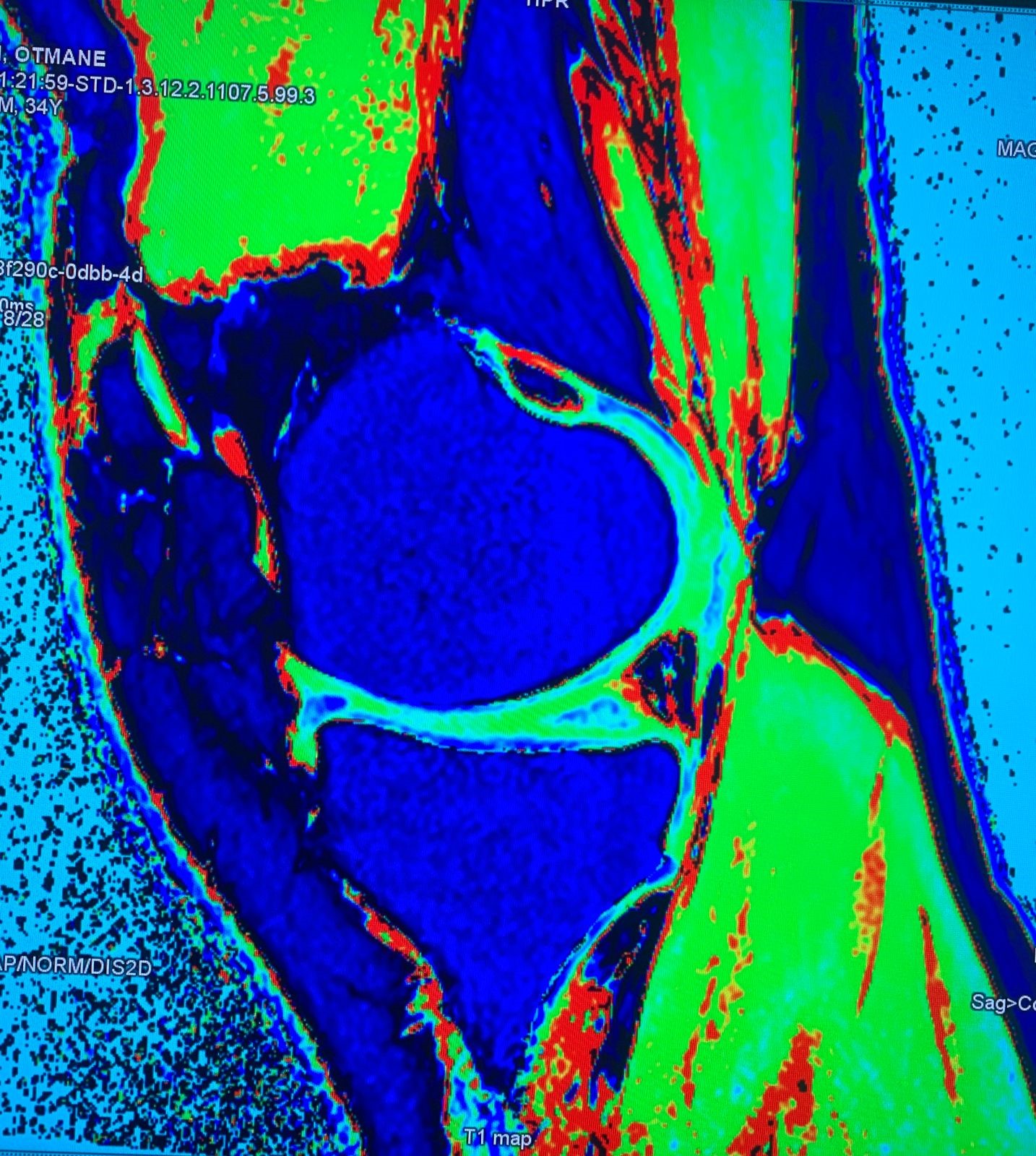 IRM du Cartilage ariculaire du Genou 